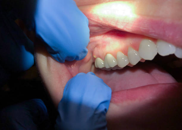 Best Broken or Chipped Tooth Repair in Amberley, OH